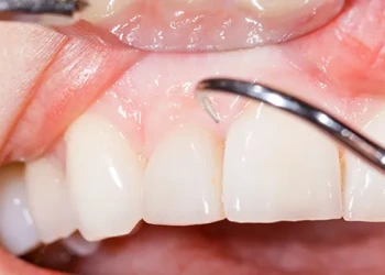 Beyaz Diş Etleri: Nedenleri, Belirtileri ve Tedavisi