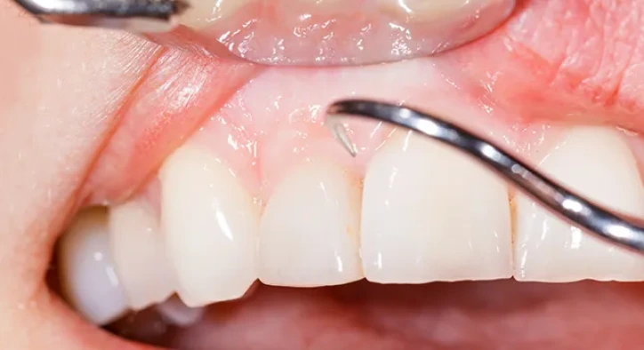 Weiße Zahnfleischbereiche: Ursachen, Symptome und Behandlung