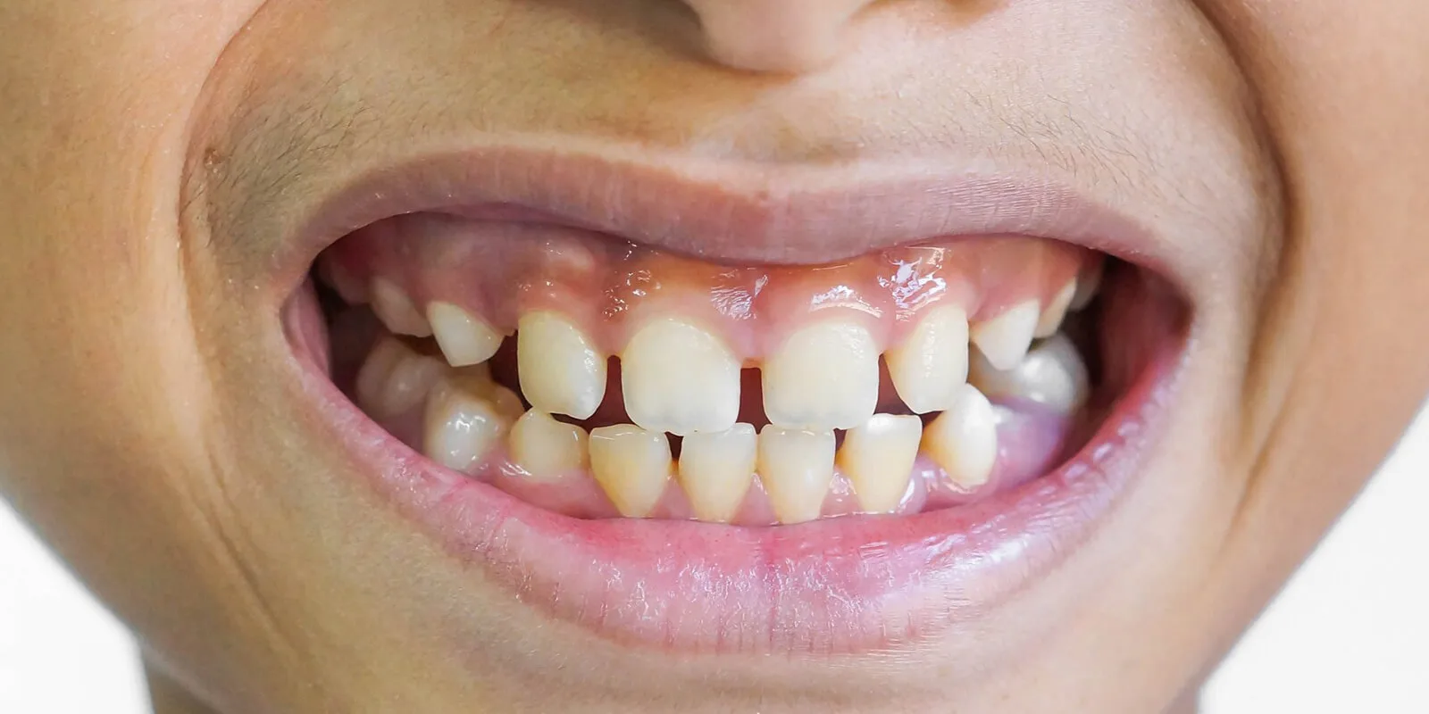 Ayrık Diş Tedavisi Nedir ve Nasıl Yapılır?