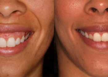 Diş Eti Gülüşü: Sebepler ve Çözümler