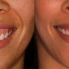 Gummy Smile: Causes, Treatments and Correction in Turkey
