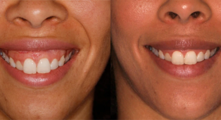 Gummy Smile: Causes, Treatments and Correction in Turkey