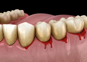 Diş Eti Sağlığı Nasıl Korunur?