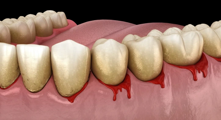 Wie Sie Ihre Zahnfleischgesundheit Erhalten