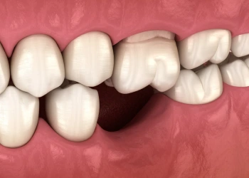 Diş Kaybı Neden Olur, Nasıl Önlenir?