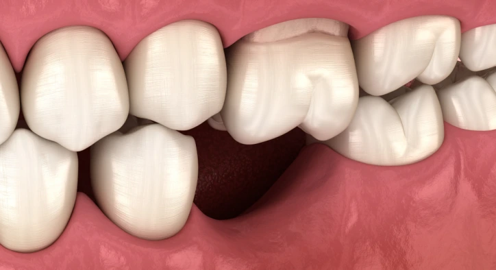 Diş Kaybı Neden Olur, Nasıl Önlenir?