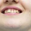 Diş Kayması Belirtileri ve Nasıl Düzeltilir?