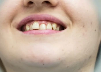 Diş Kayması Belirtileri ve Nasıl Düzeltilir?