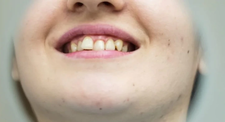 Diş Kayması Belirtileri ve Nasıl Düzeltilir?