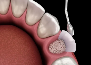 Diş Kemik Grefti Hakkında Bilmeniz Gereken Her Şey