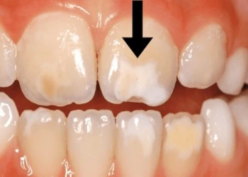 Diş Lekeleri Doğal Ürünlerle Nasıl Geçer?