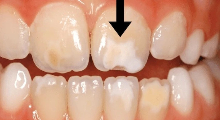 Zahnverfärbungen natürlich entfernen: Hausmittel, Grenzen und professionelle Lösungen in Antalya