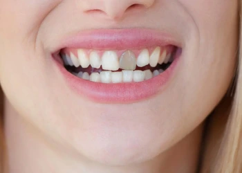 Tooth Discoloration: Causes, Types, and Treatment Options