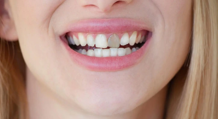 Tooth Discoloration: Causes, Types, and Treatment Options