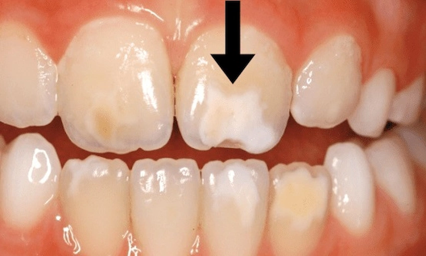 Tooth discolouration types and causes explained - Avrupa Saglik Dis dental clinic Antalya