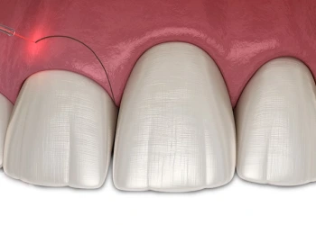 Diş Şeffaflaşması Nasıl Anlaşılır ve 3 Farklı Tedavi Yöntemi