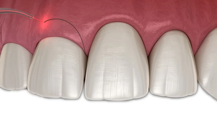 Diş Şeffaflaşması Nasıl Anlaşılır ve 3 Farklı Tedavi Yöntemi