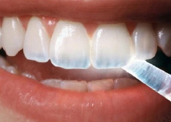Diş Şeffaflaşması Nasıl Anlaşılır ve 3 Farklı Tedavi Yöntemi
