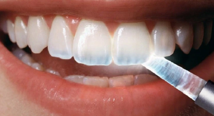 Diş Şeffaflaşması Nasıl Anlaşılır ve 3 Farklı Tedavi Yöntemi