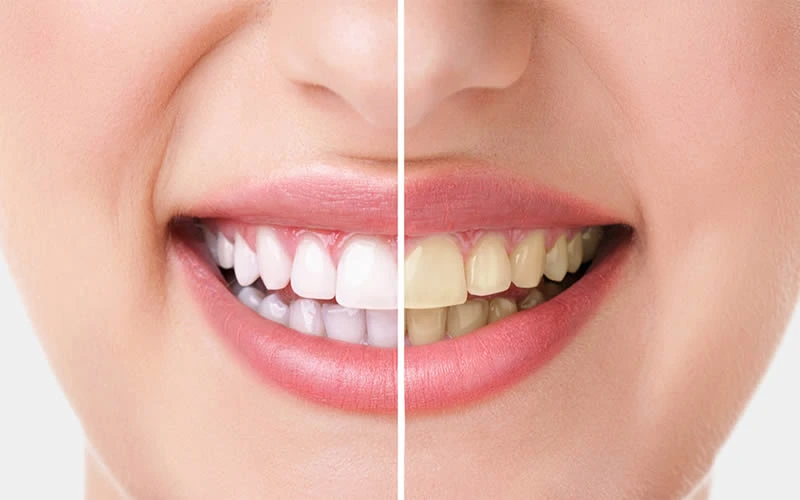 Single tooth discolouration assessment and treatment options - dental clinic Turkey
