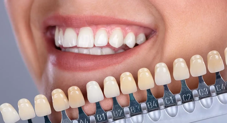 Estetik Diş Hekimliğinde En Popüler 5 Gülüş Tasarımı İşlemi