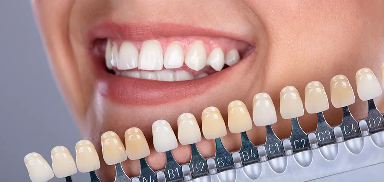 Estetik Diş Hekimliğinde En Popüler 5 Gülüş Tasarımı İşlemi