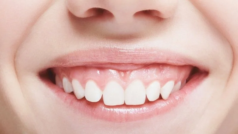 Gummy smile treatment options at Avrupa Saglik Dis clinic in Antalya Turkey