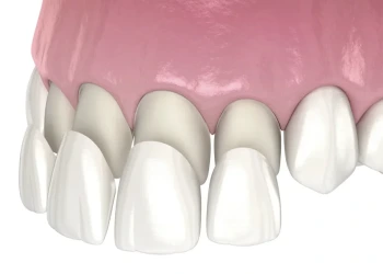 Diş Kaplaması veya Diş Kronu Nedir?