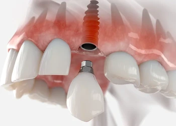 Ön Dişler İçin İmplant Tedavisi: Maliyetler ve Beklentiler