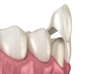 Porselen Diş Kaplama Nedir, Nasıl Yapılır?