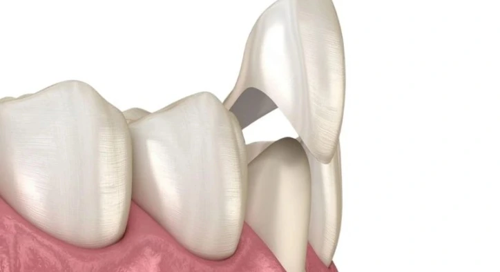 Porselen Diş Kaplama Nedir, Nasıl Yapılır?