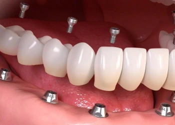 Diş Protezi Nedir ve Nasıl Yapılır?