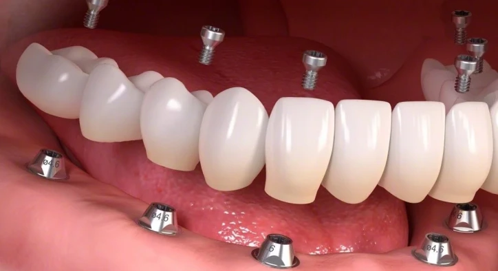 Diş Protezi Nedir ve Nasıl Yapılır?