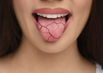 Ağız Kuruluğu Neden Olur?