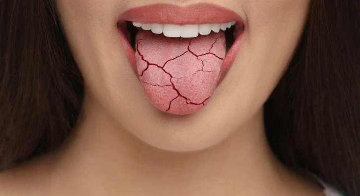 Why Does Dry Mouth Happen?
