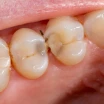 Tooth Decay and a Hole (Cavity): Differences and Treatment Options