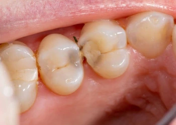 Diş Çürüğü ve Çukur (Kavite): Farklar ve Tedavi Seçenekleri