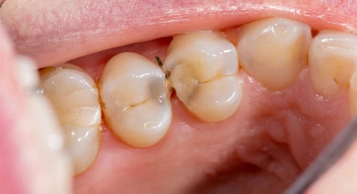 Diş Çürüğü ve Çukur (Kavite): Farklar ve Tedavi Seçenekleri