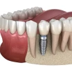 What Is a Dental Implant Abutment? Its Role and Importance
