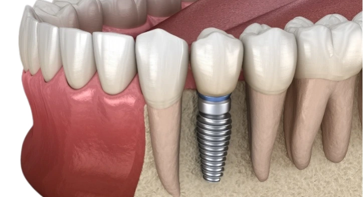 What Is a Dental Implant Abutment? Its Role and Importance