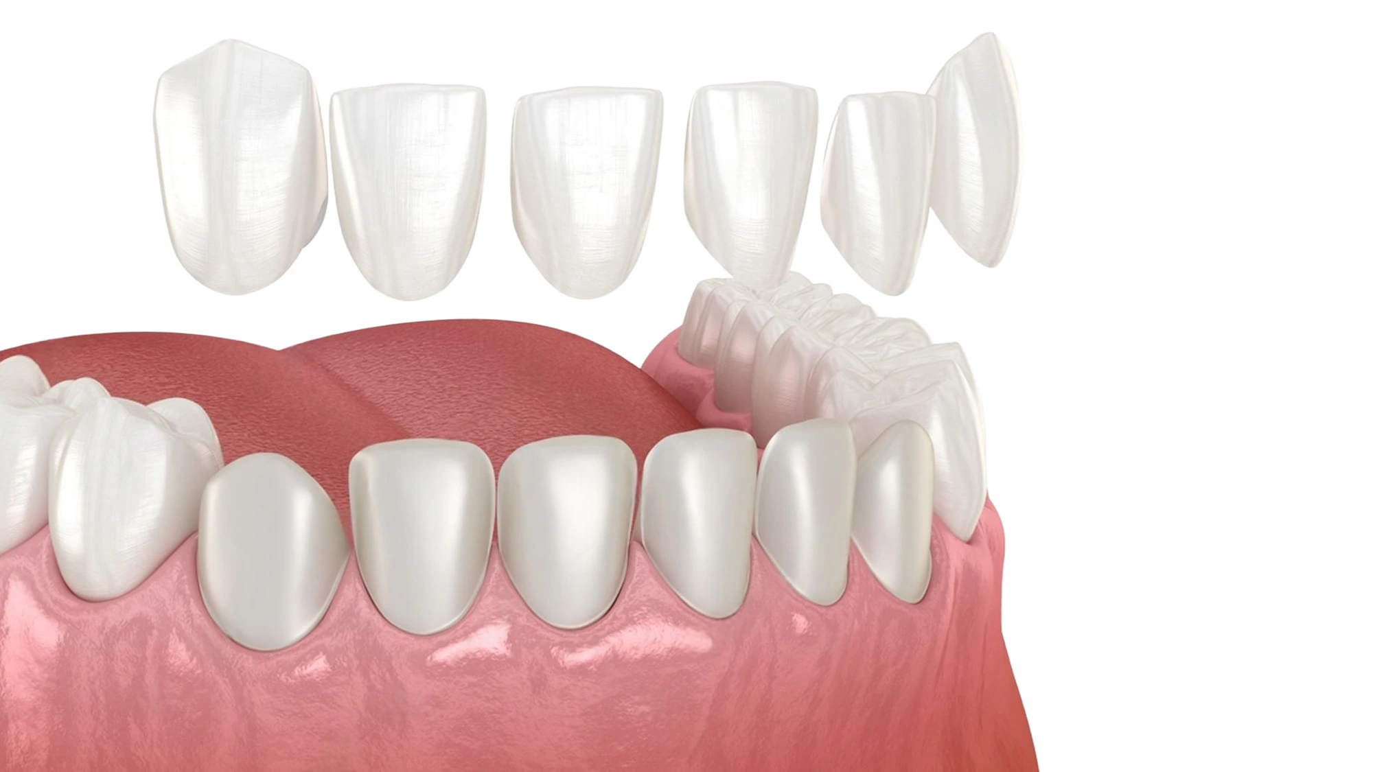 Dental veneer options and treatment planning at Avrupa Saglik Dis Antalya dental clinic