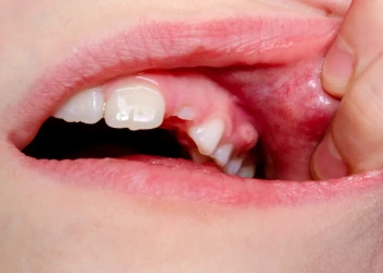 Diş Apsesi Nedir, Nasıl Geçer?