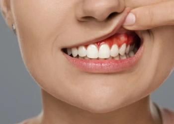 Zahnfleischschwellung: Ursachen, Symptome und Behandlungsmöglichkeiten