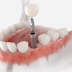 Different Types of Dental Implant and Their Advantages and Disadvantages