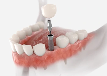 Farklı Diş İmplantı Türleri ve Avantajları ile Dezavantajları