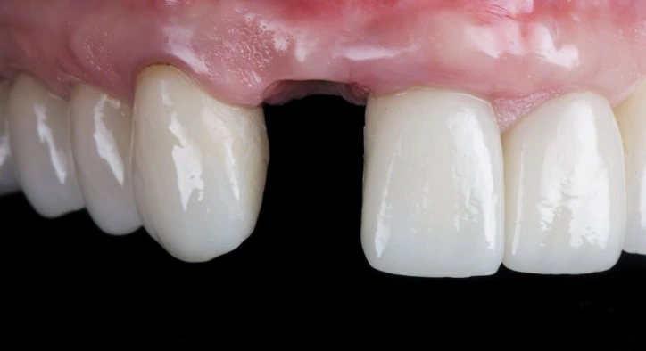 Zahnverlust: Symptome, Ursachen und was zu tun ist