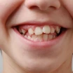 What You Need to Know Before Braces: A Step-by-Step Preparation Guide