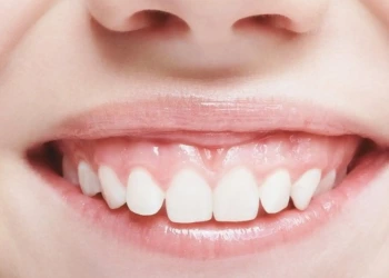 Everything You Need to Know About Gummy Smile