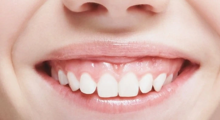 Everything You Need to Know About Gummy Smile