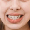 What is Malocclusion? How is it Treated?